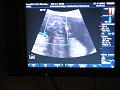 16-02-06 20 weken echo (10)